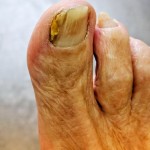 Fungal Nail