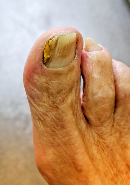 Fungal Nail Treatment at Walk This Way Podiatry - Haberfield & Putney