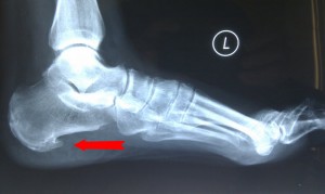 Heel Spur